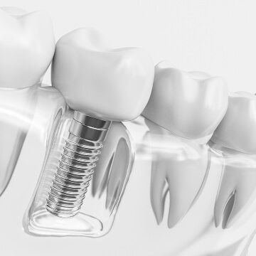 インプラント入れ歯・ブリッジ